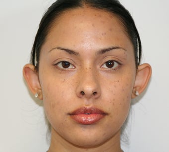 Otoplasty before 320201