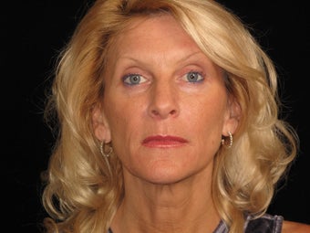 Botox and Restylane after 323691