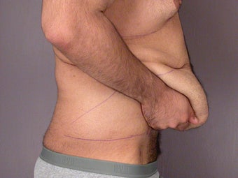After Weight Loss Male Tummy Tuck before 280821