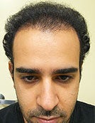 FUE – SFET Using Nape and Head Hair for conservative hairline after 196040