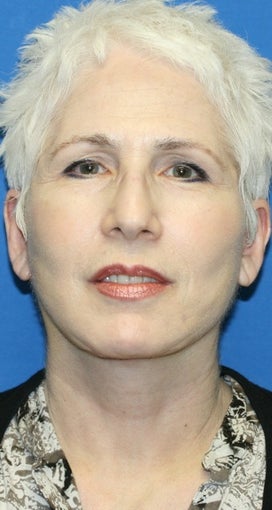 Short Incision face lift and neck lift after 223338