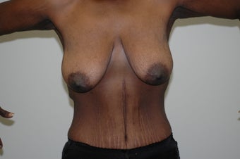 Arm Lift (brachioplasty) before 333738