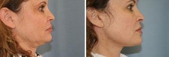 52 year old. Two month status post neck lift. before 343915