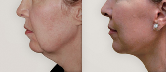 Neck Lift before 359134