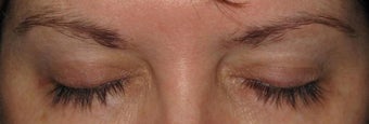 Latisse before and after after 109633