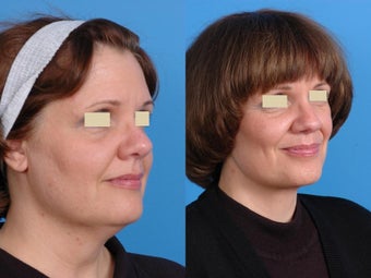 Facelift Results before 139613