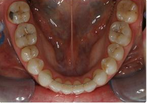 Orthodontic treatment without extraction of teeth after 546583