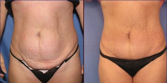 Mini Tummy Tuck before 98608