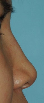 Non Surgical Rhinoplasty before 308293