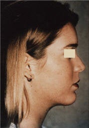 Chin Implant/Necklift/MiniLipo after 101596