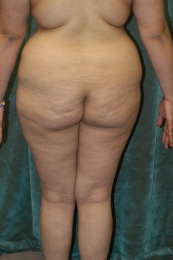 Buttocks Augmentation 518110