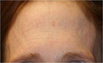 Fraxel - Photoaging after 652364