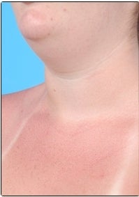 Smart Lipo, Neck Liposuction before 607447