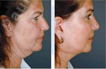 Complete Facial Rejuvenation 138180