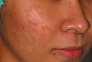 PDT for acne after 376122