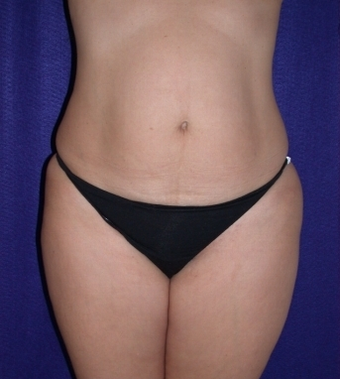 Tummy Tuck (abdominoplasty) before 208470