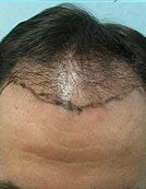 Head FUE and Leg BHT before 195646