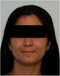 Evolence Injection in Smile Lines before 123626