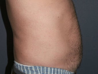 Body Liposculture 486600