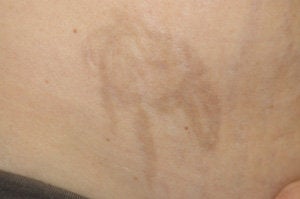 Laser Tattoo Removal Photos after 203267