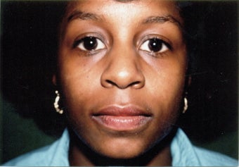 Rhinoplasty before 383007