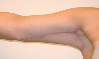 Brachioplasty (Arm Lift) After Massive Weight Loss (Front View) after 65365