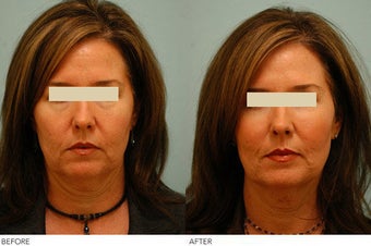Injectable Fillers (Restylane/Perlane) before 136770