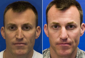 Revision Rhinoplasty with Rib cartilage graft before 295353