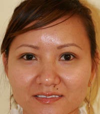blepharoplasty (eyelids) after 219356