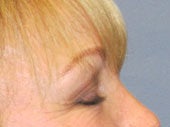 Brow Lift 541495