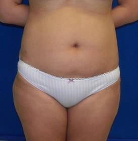 Laser Liposuction after 220308
