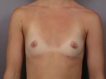 Breast Augmentation before 467306