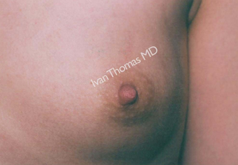 Nipple Surgery after 243257