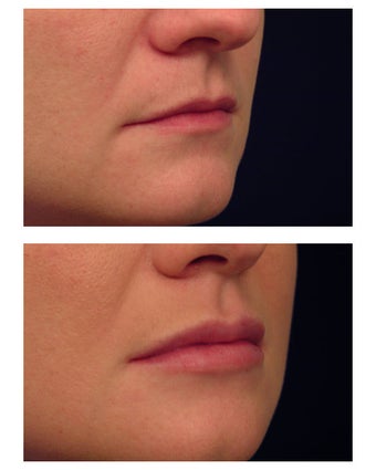 Restylane for lip augmentation after 82764