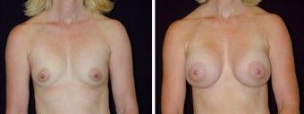 21 year old female, breast augmentation, San Francisco, California before 628366