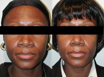 African American Rhinoplasty before 210145