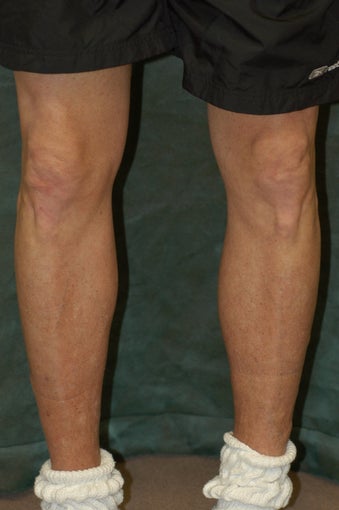 Men's Calf Augmentation 519059