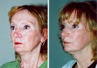 Non-Surgical Face Lift- Exoderm before 242970