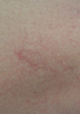 Spider Vein Removal for the Legs after 106555