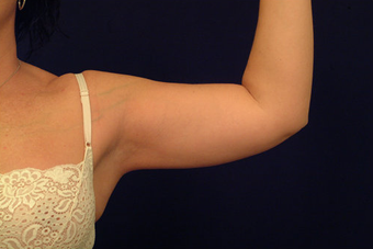 Liposuction before 393227