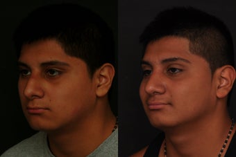 Rhinoplasty 305996