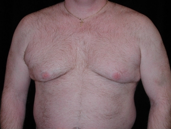 Cool Lipo before 245621