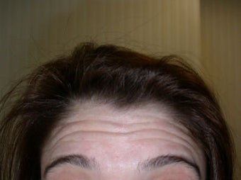 Botox before 295380