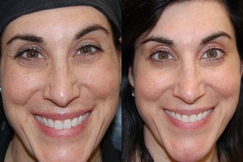 Botox Cosmetic to treat Crow's Feet before 172554