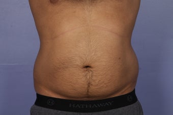 Liposuction before 526783