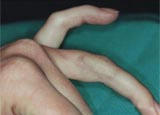Tattoo Removal after 123389