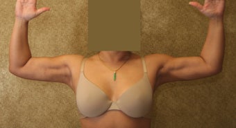 liposuction of arms for women after 583554
