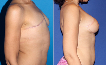 Breast Reconstruction before 331096