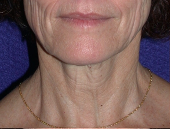 Necklift before 208444