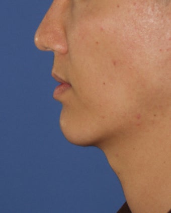 Chin Implant 414146
